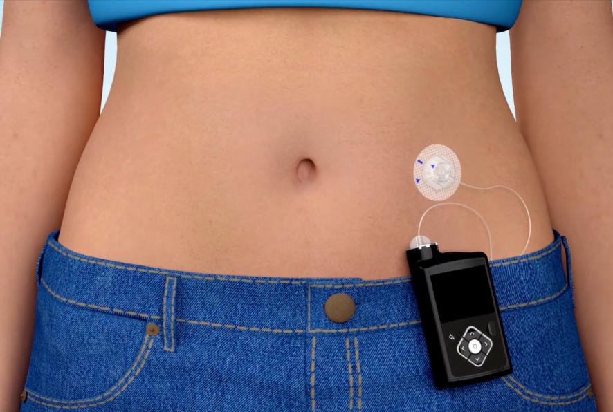 insulin pump, diabetes management, blood sugar control, insulin therapy, personalized care, diabetes technology, continuous glucose monitoring, diabetes treatment, insulin delivery, smart insulin pumps,