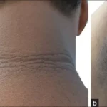 Acanthosis nigricans, skin