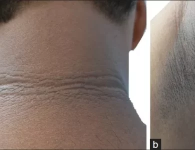 Acanthosis nigricans, skin