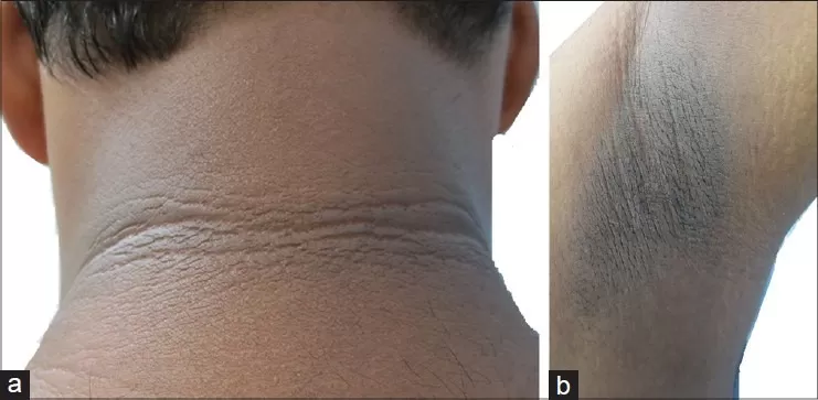 Acanthosis nigricans, skin